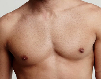 Gynecomastia Surgery Recovery